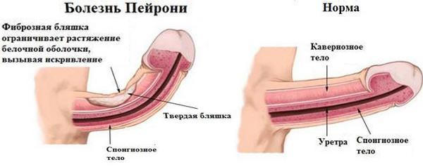 Форма члена болезнь Пейрони